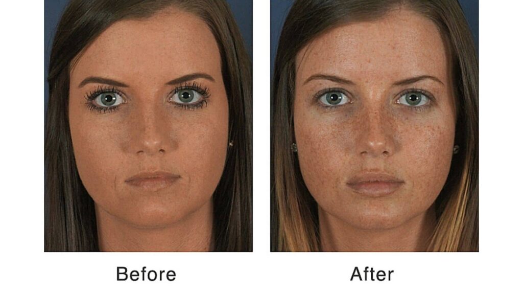 Filler before and after